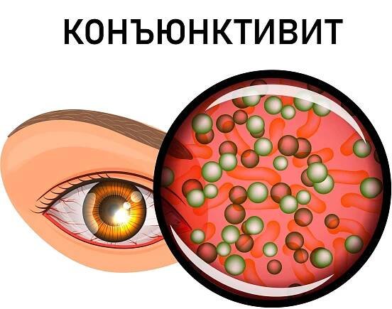 Конъюнктивит