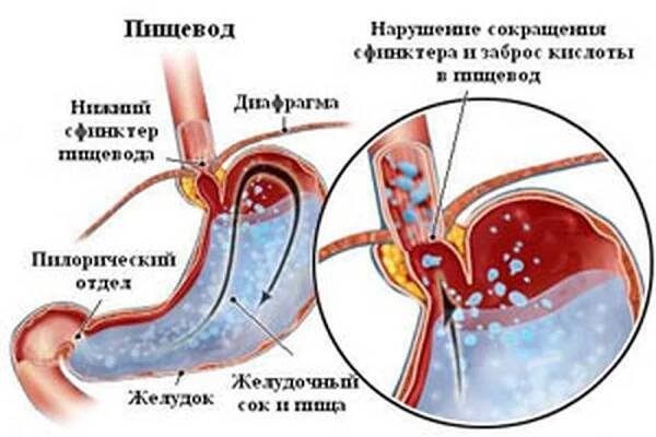 Příznaky refluxní esofagitidy a metody léčby / Refluxní ezofagitida