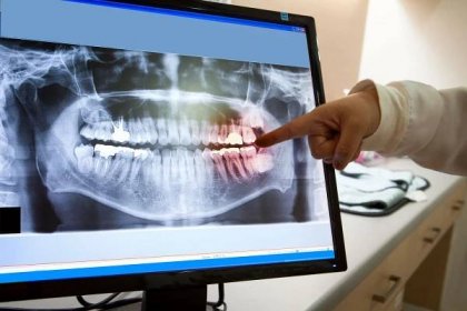 panoramatický dentální rentgenový film pro zubaře - nemocnice fotky - stock snímky, obrázky a fotky