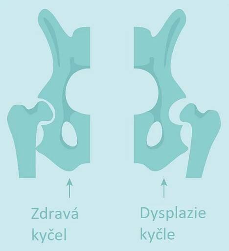 Dysplazie kyčle - ilustrace