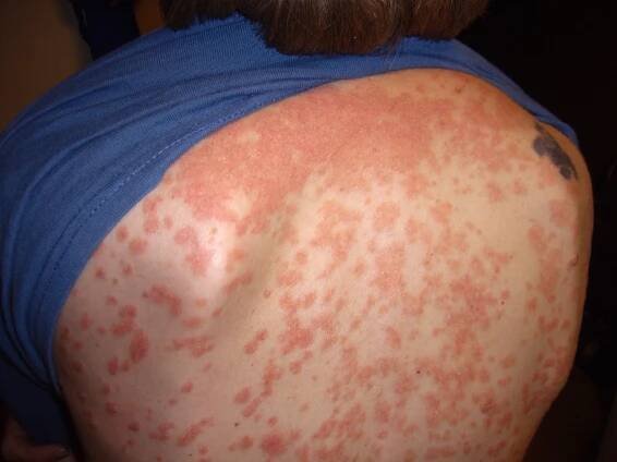 Conditions Related to Psoriatic Arthritis