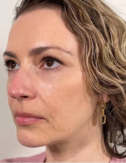 EMFACE® Facial Rejuvenation in North Vancouver & Vancouver, BC