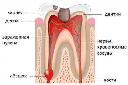 Symptomy a léčba abscesu zubů / Absces