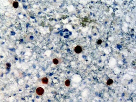 Shorter Washout Better for Natalizumab-to-Fingolimod Switch