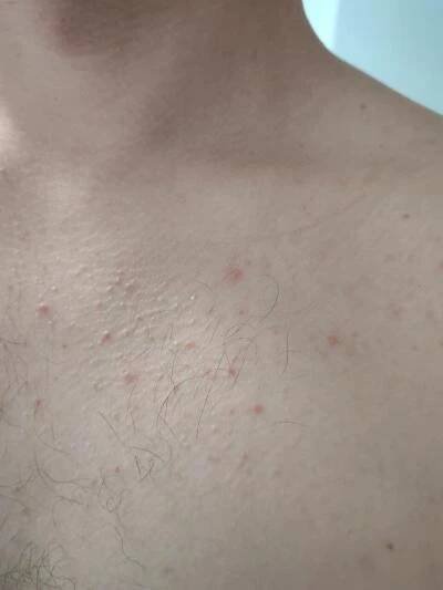 Alergie a ekzémy | Kožní vyrážka co to může být