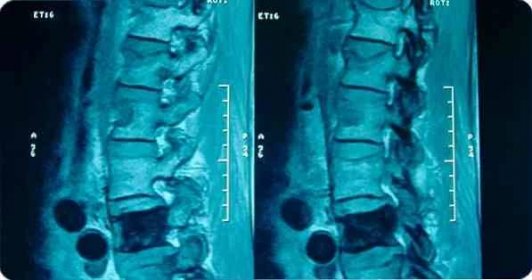 Symptomy a léčba spinální enotózy / Ortopedie a traumatologie | Užitečné informace a tipy na péči o sebe. Zdraví, výživa
