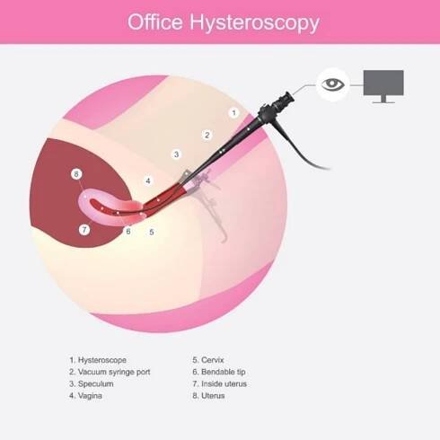 Hysteroskopie: diagnostická a operační metoda děložních polypů. 1 - hysteroskop, 2 - port pro vakuovou stříkačku, 3 - zrcadlo, 4 - pochva, 5 - děložní hrdlo, 6 - ohebný hrot, 7 - vnitřek dělohy, 8 - děloha. Zdroj: Getty Images