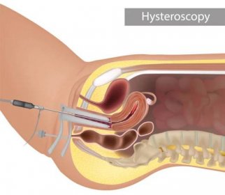 anatomická ilustrace hysteroskopického postupu. kontrola děložní dutiny endoskopií. postup hysteroskopie - děložní sliznice děložní stěna stock ilustrace