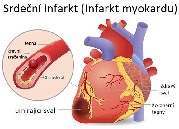 Srdeční infarkt (Infarkt myokardu) - ilustrace