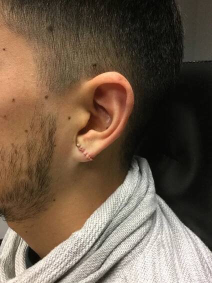 Earlobe Repair
