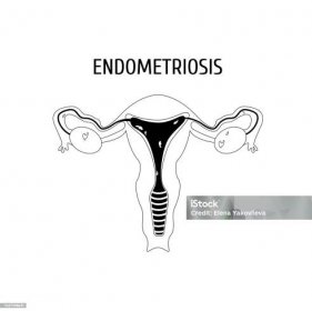 Obrys ženských genitálií. Endometrióza - Bez autorských poplatků Anatomie vektorové obrázky