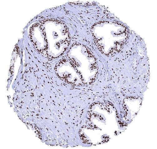 Prostate - A strong nuclear Androgen Receptor immunostaining is seen in stromal and epithelial cells of the prostate.