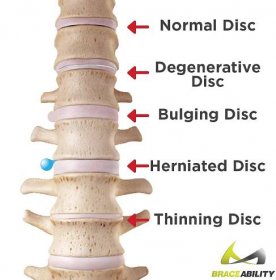 graphic about the types of spine problems you can have from being overweight