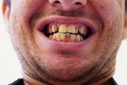 Pryč s křivými zuby díky fixním rovnátkům