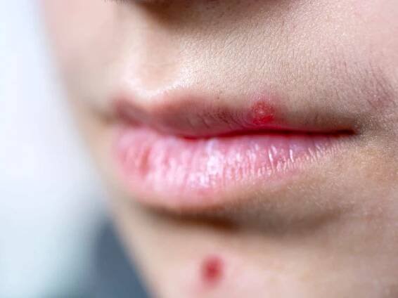 Pimple on lip: Causes, treatment, and prevention