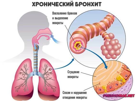 Chronická bronchitida