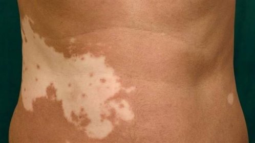 Světlé nepravidelné skvrny na kůži, odborně vitiligo, mohou být projevem...