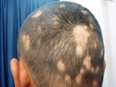 Alopecie, plešatost, holohlavost – příznaky, projevy, symptomy - Příznaky a projevy nemocí