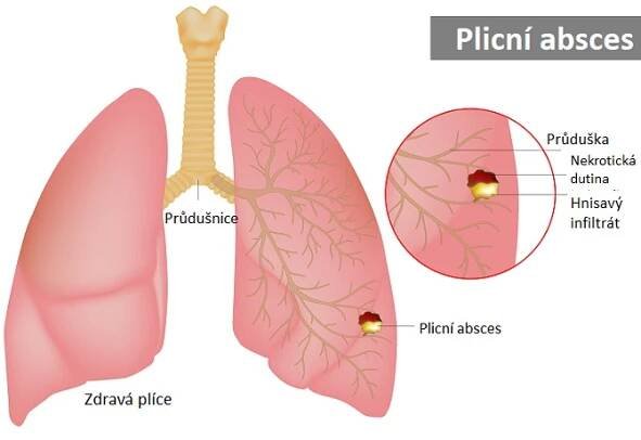 Plicní absces - ilustrace