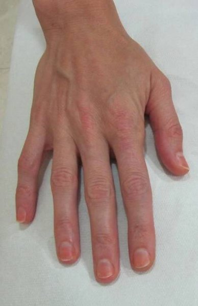 Fat Filler Treatment in dubai