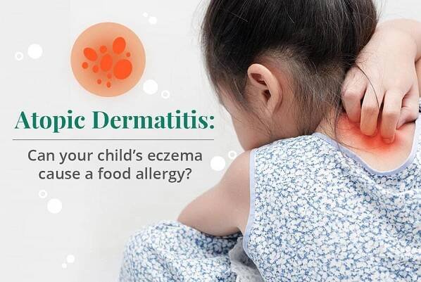 Alergie na jednorázové plenky a atopická dermatitida u kojenců: příznaky, rady a jak se vyvarovat