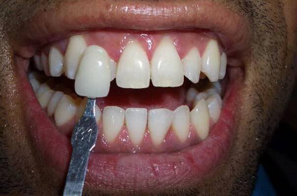 Teeth Whitening - Pont Street, London Dentist - Treatments