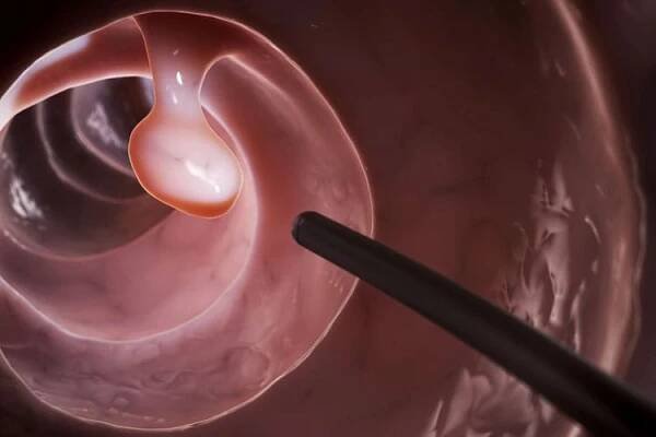 Colonoscopy: examination of the colon