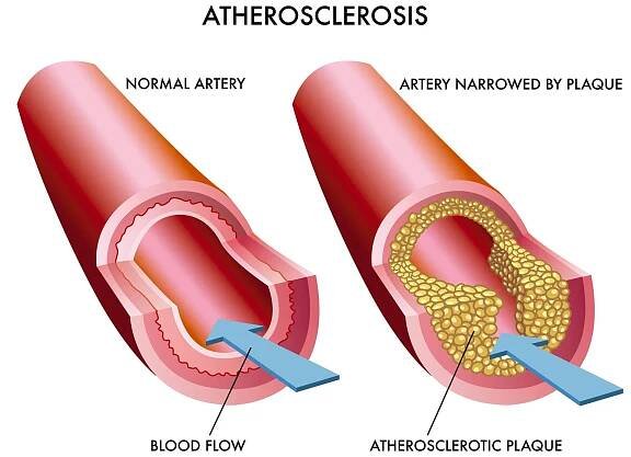 Atherosklerose Stock-Vektorbilder