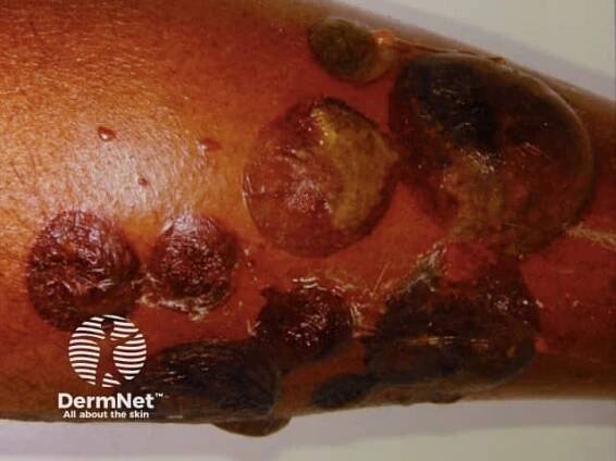 Bullous Pemphigoid: Causes, Symptoms, and Treatment — DermNet