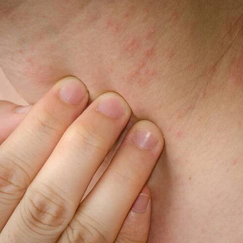 ekzém kůže na krku - kontaktní dermatitida - stock snímky, obrázky a fotky