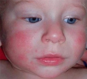 Vyrážka u novorozence a jednoho měsíce staré dítě: příčiny červené vyrážky s vysvětlením, červené a malé vyrážky na těle