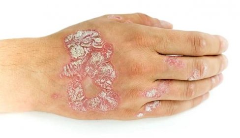 Psoriasis vulgaris a plísní na člověka ruky a prstů s plaku, vyrážka a patche, izolované na bílém pozadí. Autoimunitní onemocnění genetické. — Stock obrázek
