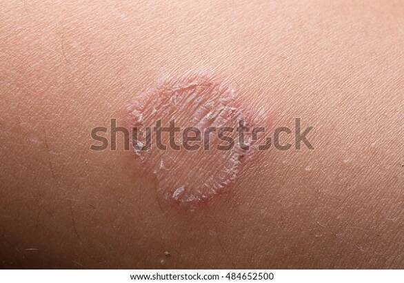 Ring Worm infekce, dermatofytóza na kůži Stock fotografie 484652500