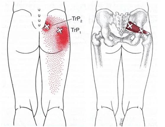 Piriformis Trigger Points - Muscle Pain