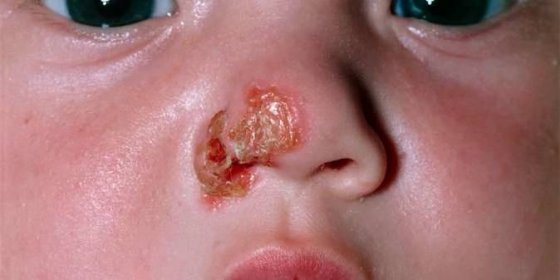Impetigo je vysoce nakažlivé bakteriální kožní onemocnění, postihující vrchní vrstvu pokožky, které se projevuje úpornou puchýřovitou vyrážkou. Nejčastěji postihuje děti v batolecím a předškolním věku a objevuje se zejména v letních měs�ících. 