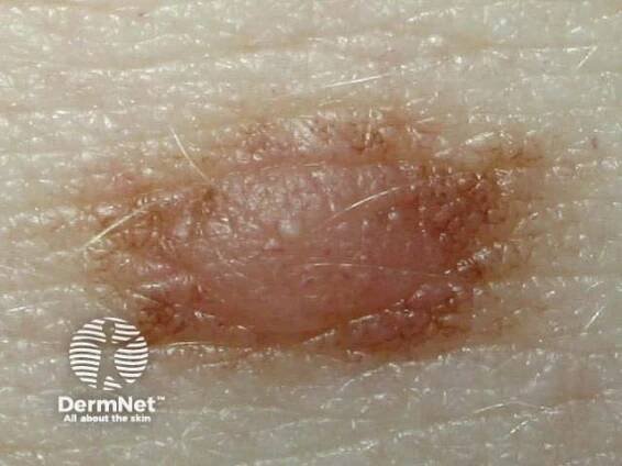 Moles (melanocytic naevi, pigmented nevi)