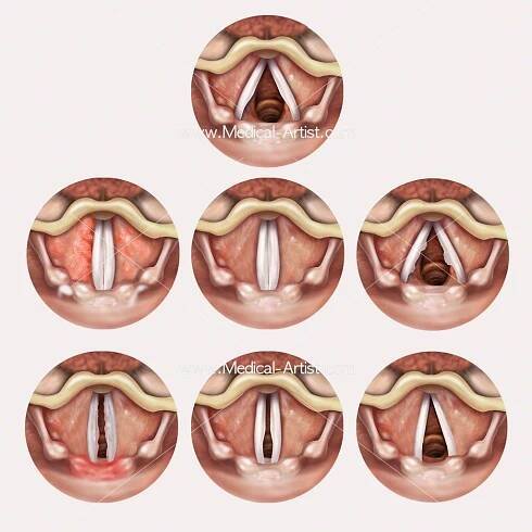 Vocal cord conditions