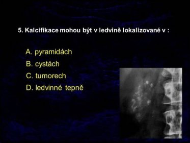5. Kalcifikace mohou být v ledvině lokalizované v : A. pyramidách B. cystách C. tumorech D. ledvinné tepně.