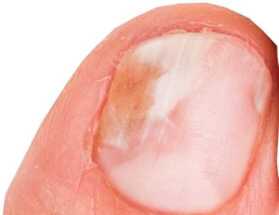 Nagelpilz am Finger