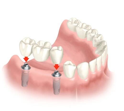 Zubní implantáty cena Ústí nad Labem - Zubní klinika Petrovice