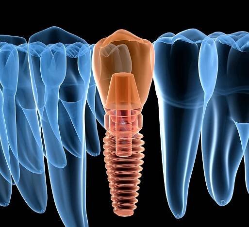 xray of a dental implant in the jaw