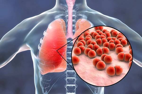 Váháte mezi očkováním proti pneumokoku a meningokoku? Známe ideální odpověď