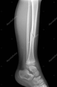 Zlomená noha rentgeny obrázek ukazující desku a šroub fixace holenní a lýtkové kosti