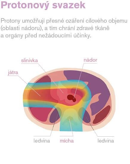 Proč zvolit protonovou léčbu - Protonové Centrum