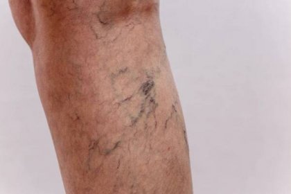 Your Dark & Bulging Veins Can Be a Sign of a Deeper Issue