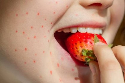 Potravinové alergie jahodový a abstraktní alergickou reakci na dívčí tvář — Stock obrázek