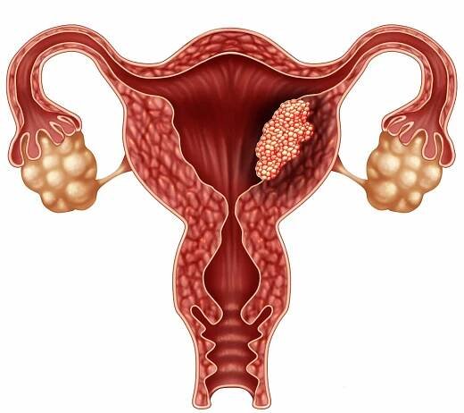Endometriální karcinom koncept — Stock obrázek