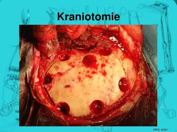 PPT - Kraniocerebrální poranění PowerPoint Presentation, free download - ID:4054087