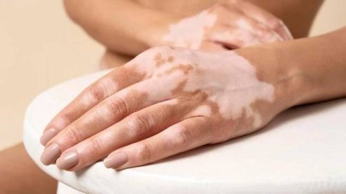 ŽENA-IN - Bílé skvrny na kůži konzultujte s lékařem. Vitiligo může ukazovat na závažnější zdravotní problém