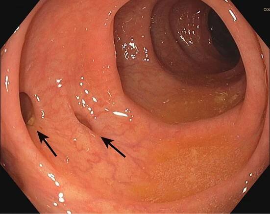 Diverticulosis